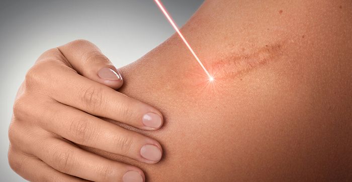 Tratamento para cicatrizes