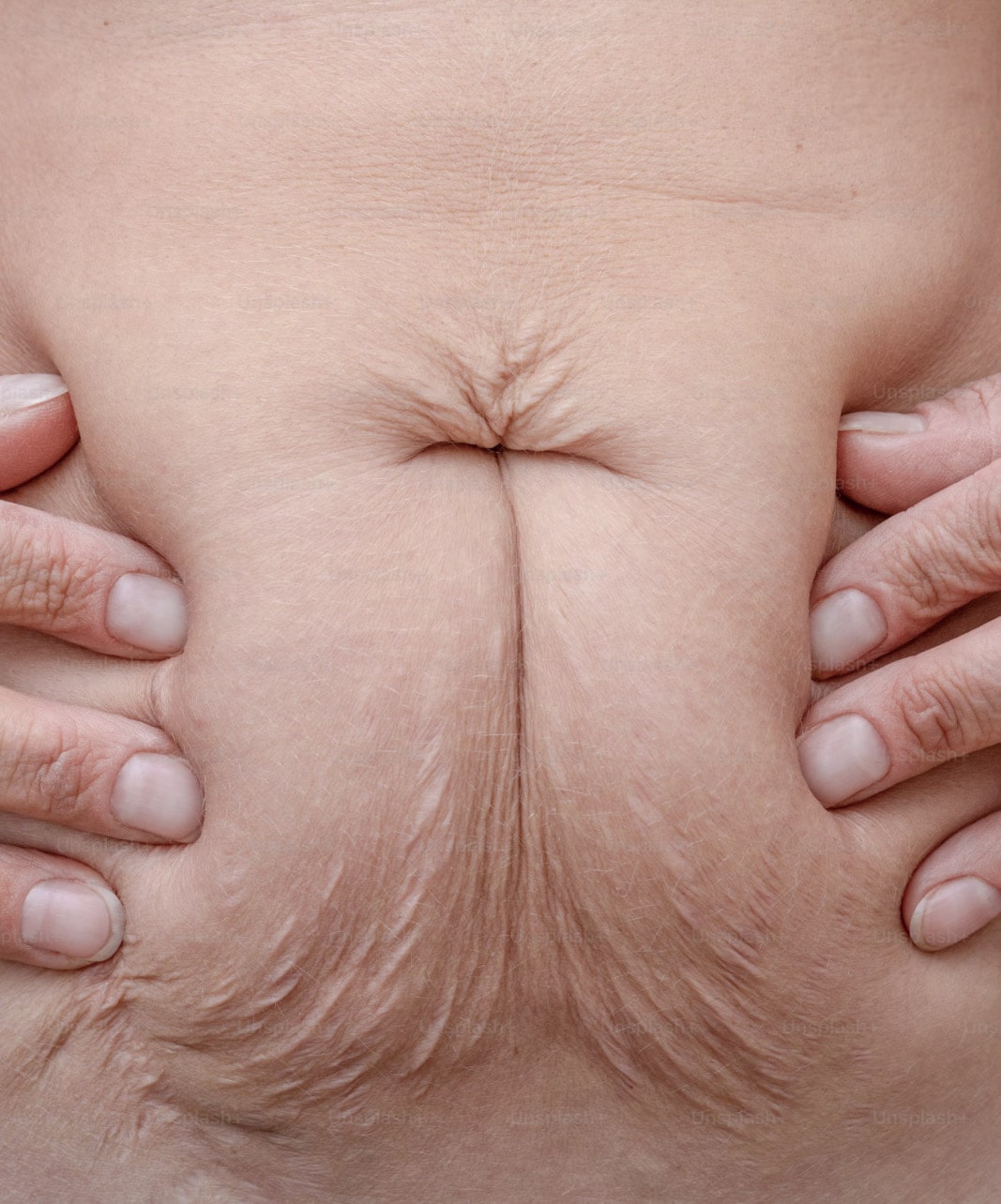 Di&aacute;stase Abdominal