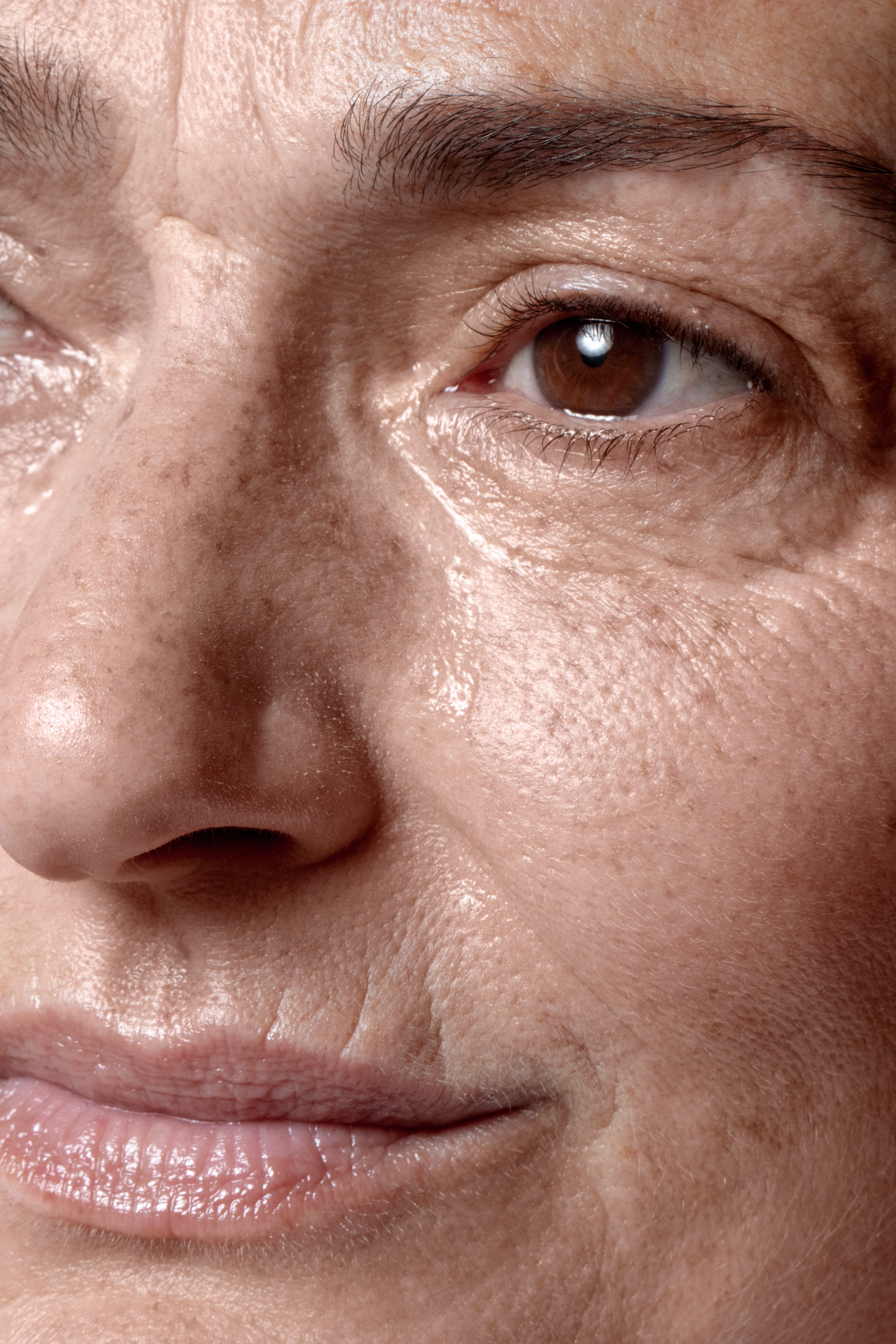 melasma botox